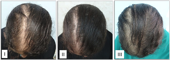 Carboxytherapy hair loss before and after