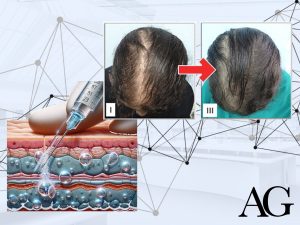 carboxytherapy for hair loss
