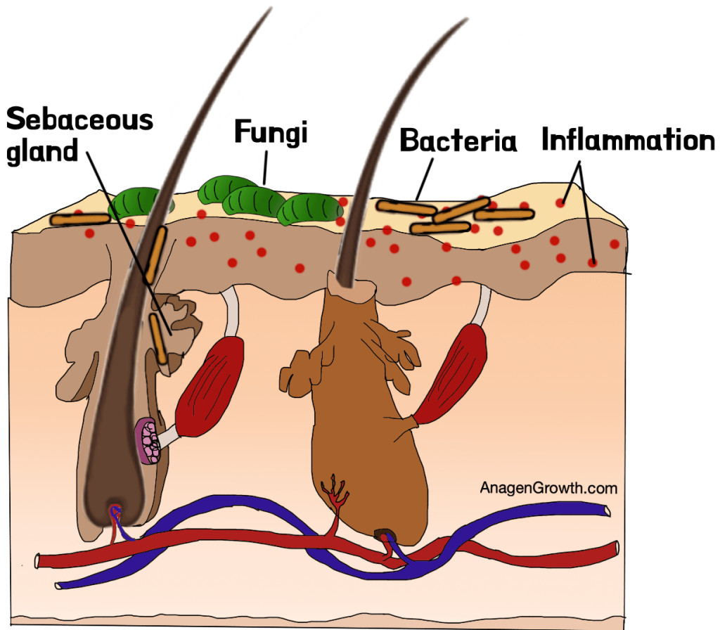 Bacteria and yeast causing scalp inflammation and hair loss