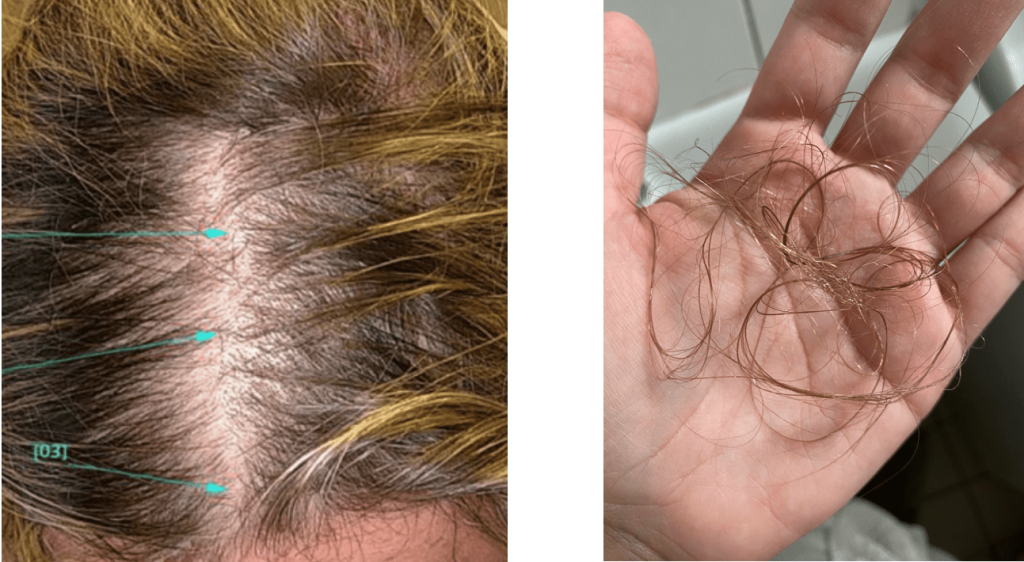 Telogen effluvium scalps 