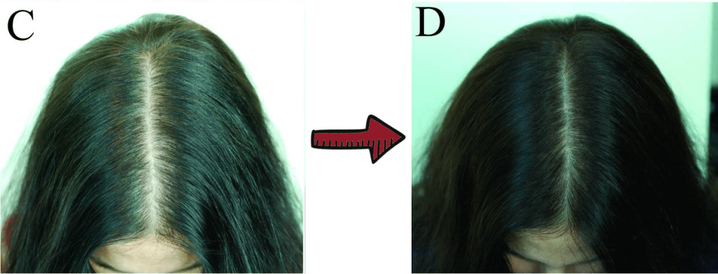 hair growth before and after picture of green tea extract trial