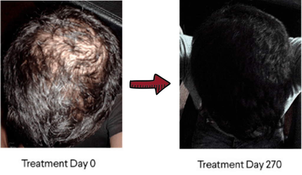 hair growth before and after picture of EGCG trial