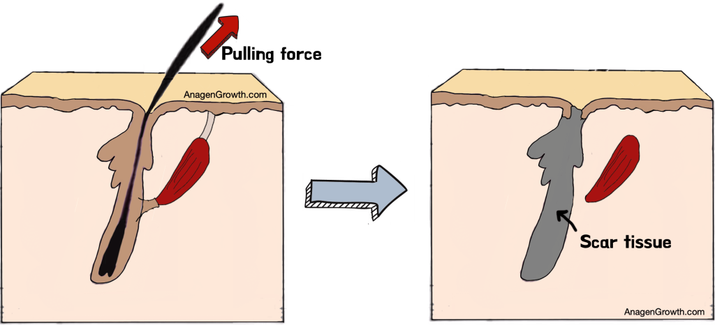 traction alopecia fibrotic 
 tissue illustration