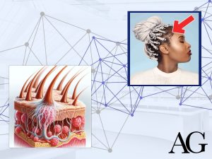 traction alopecia article thumbnail