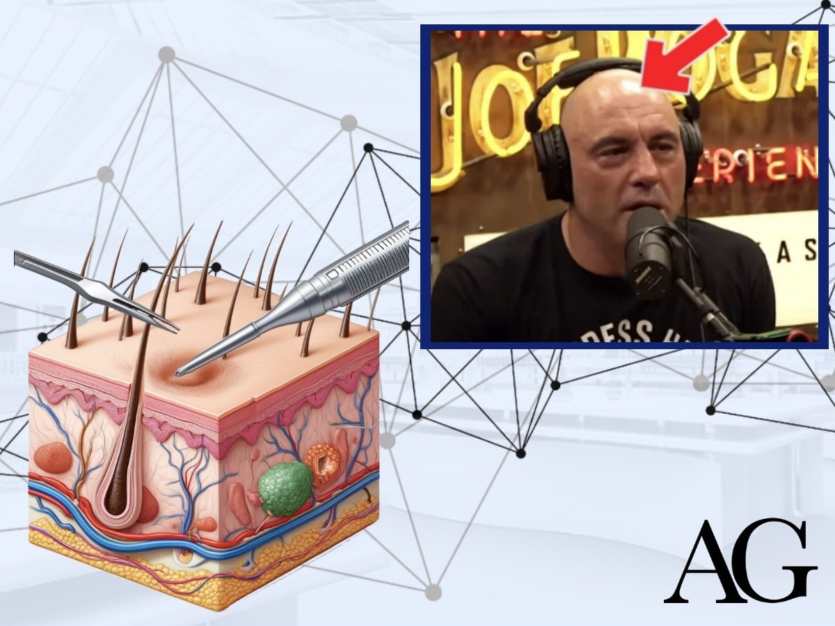 are hair transplants permanent article thumbnail with joe rogan