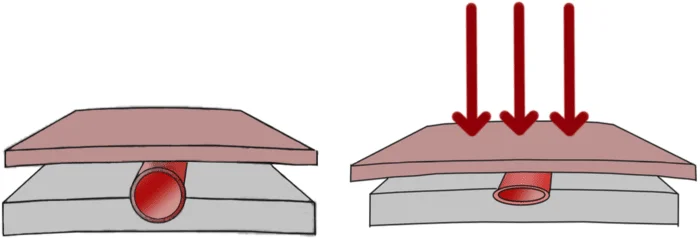 constricted scalp blood flow