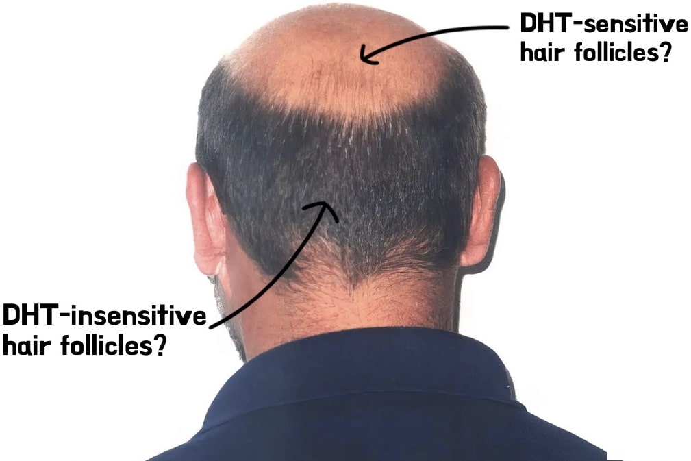 hair dht sensitivity