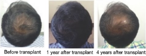 hair transplant before and after