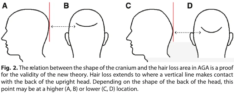 head shape hair loss study