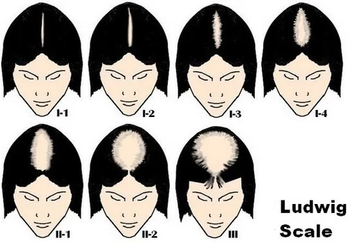 female pattern hair loss ludwig scale