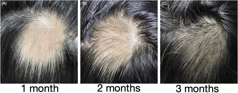 turmeric alopecia areata before and after