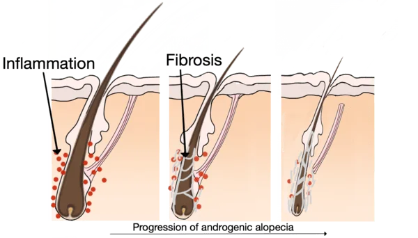 follicular fibrosis miniaturisation