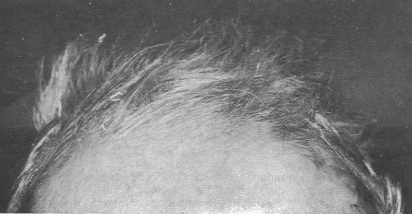 scalp four months after burn