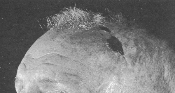 scalp 6 weeks after burn