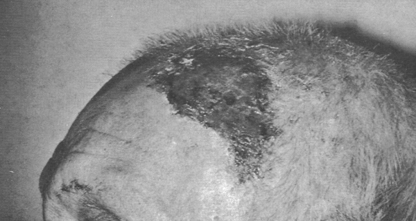 scalp two weeks after burn 