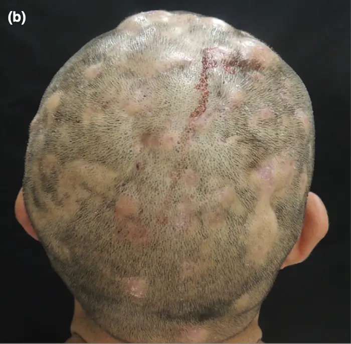 alopecia after steroid usage